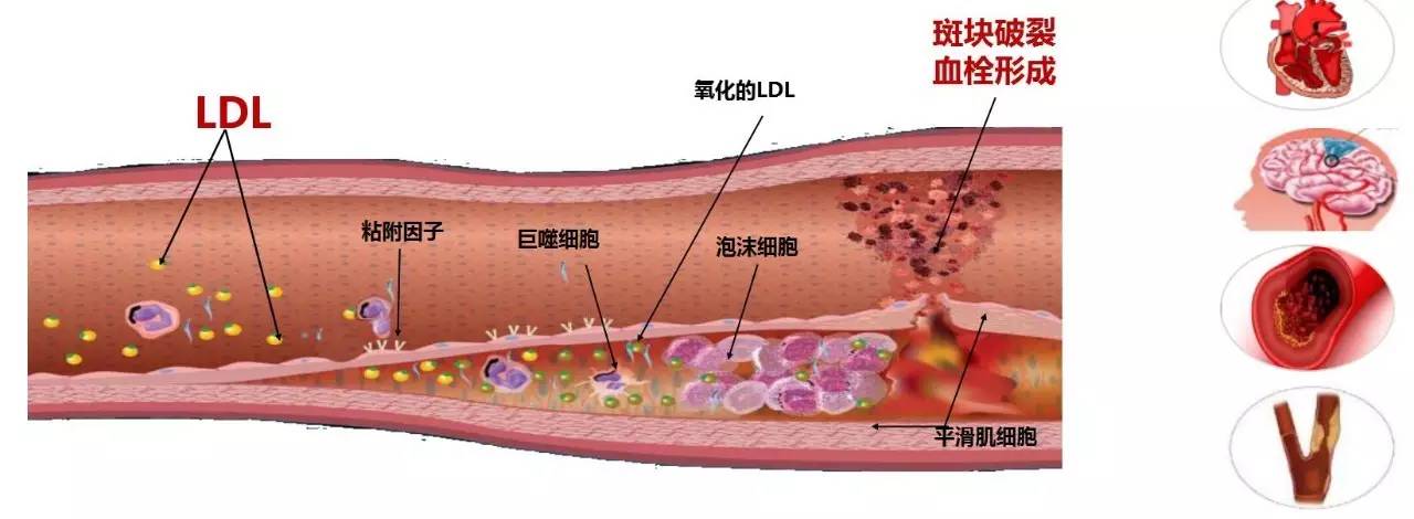 动脉粥样硬化(as)发病机制有多个假说,但目前能够从遗传学,病理生理学