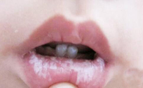 嘴唇白色念珠菌的图片图片