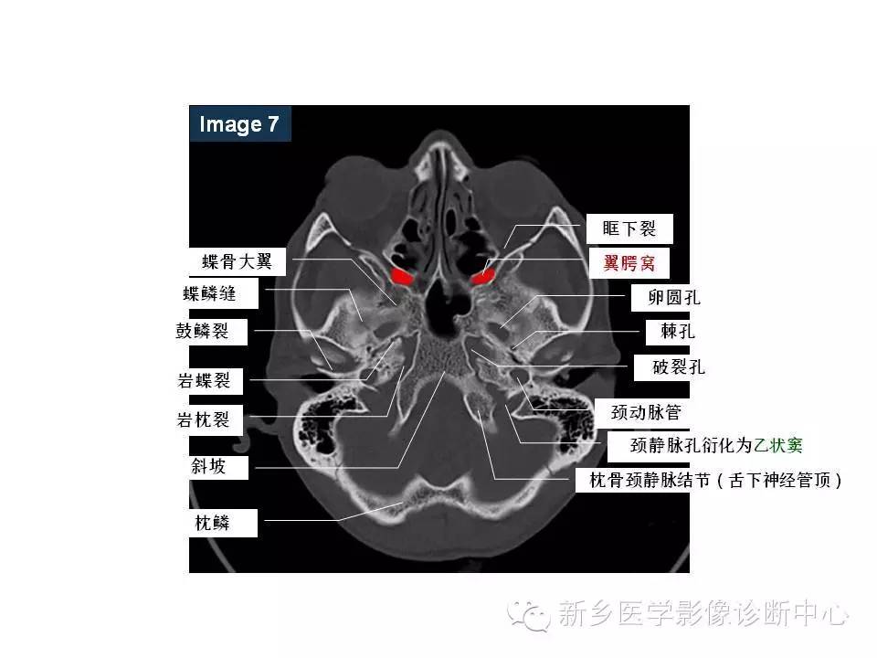 鼻咽部的詳細解剖(含各個孔道)