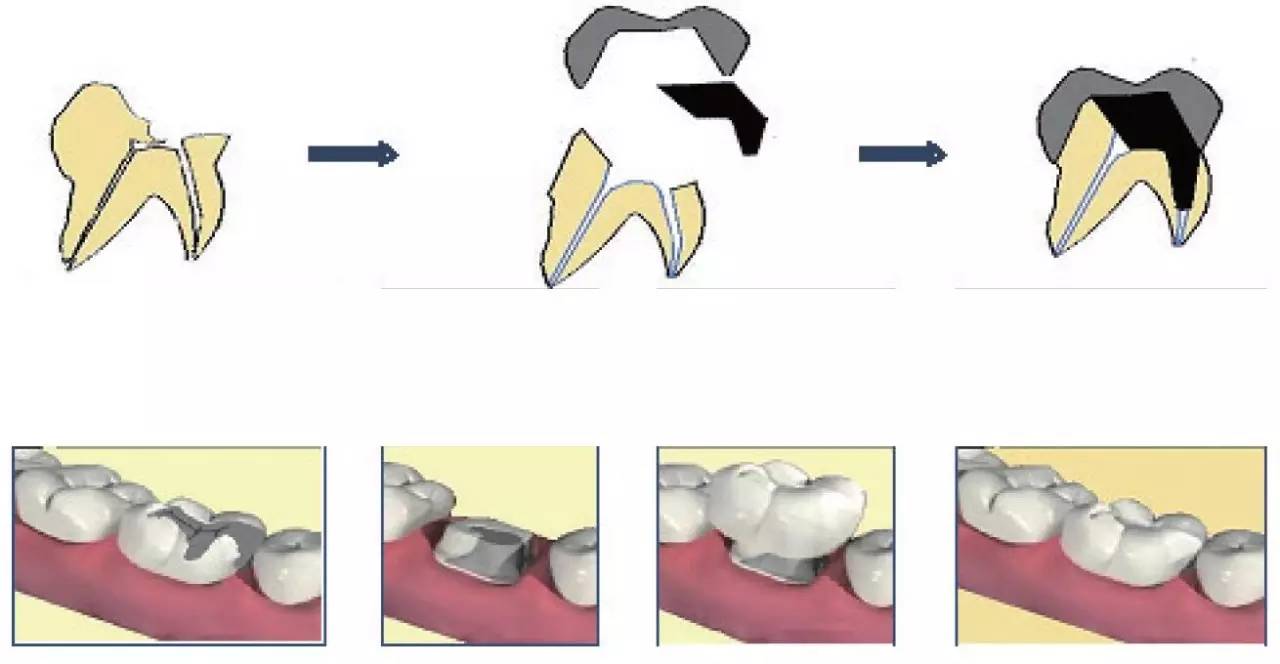 李鸿波教授介绍,口腔修复医师在临床工作中经常遇到低牙合龈距后牙