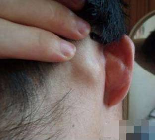 耳后乳突疼痛图片