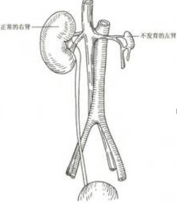 马蹄肾怎么治疗图片