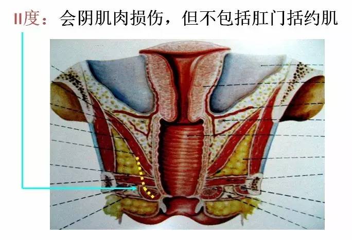 医学笔记︱会阴撕裂伤的分类,看这几张图就够了