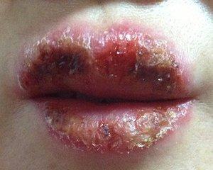 嘴唇化脓性肉芽肿图片