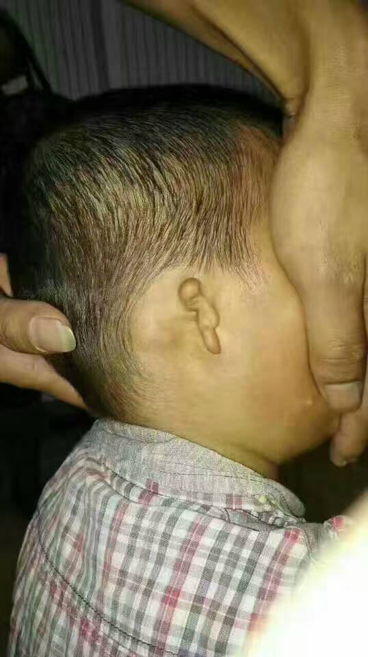 婴幼儿外耳道畸形的精准干预