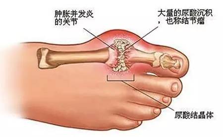 抗毒素和类毒素的区别