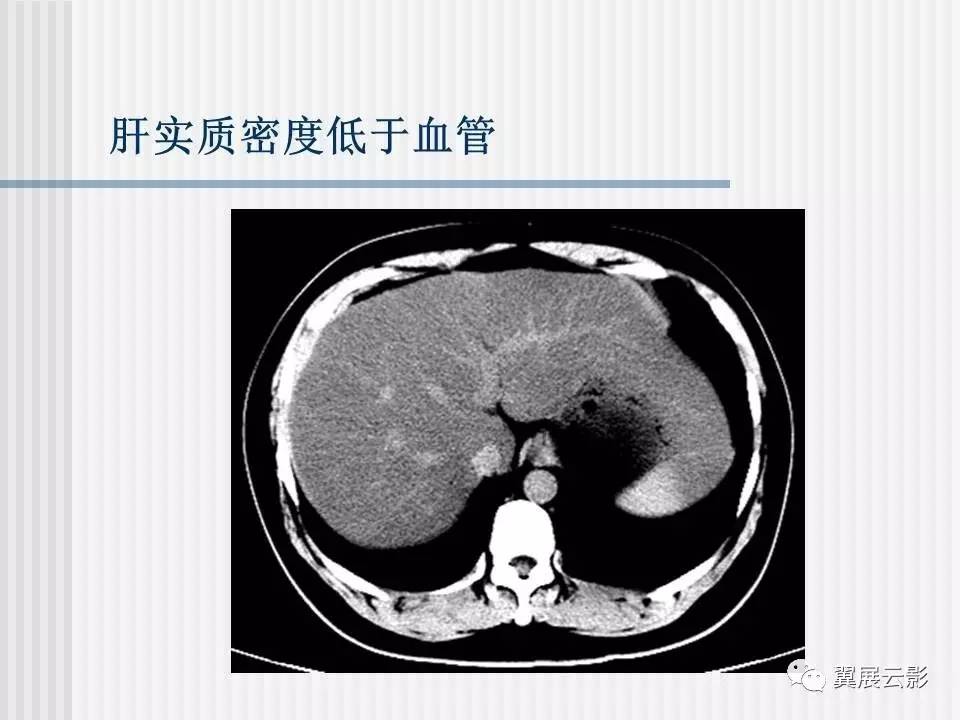 脂肪肝ct图图片