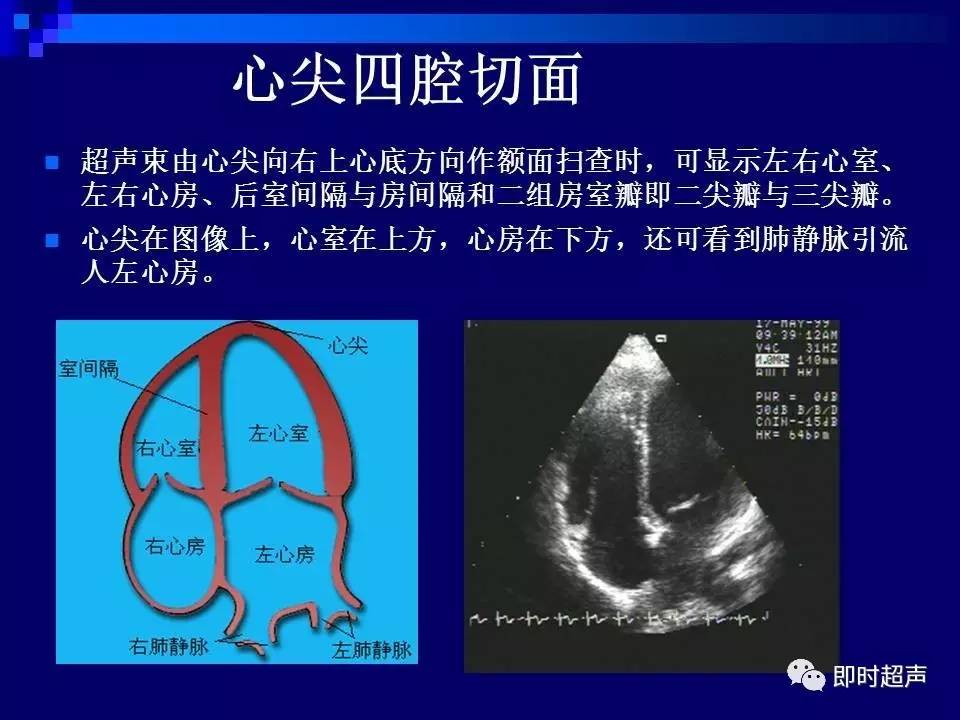 心脏彩超四腔心解剖图图片