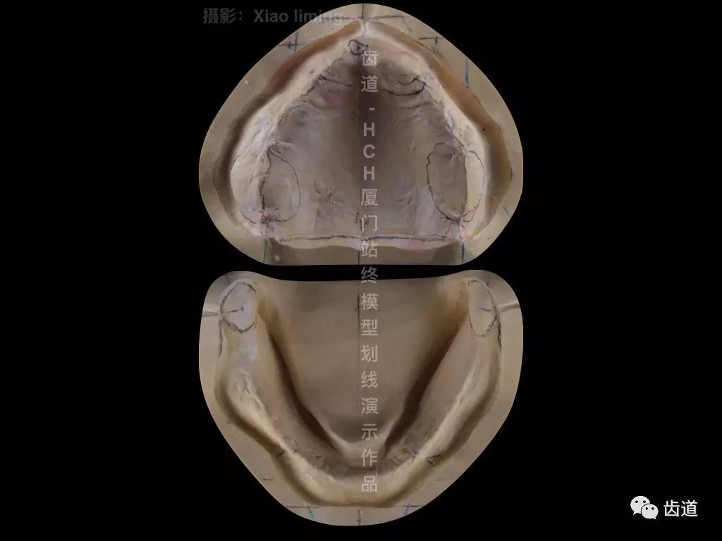 多流程取印模及颌位关系全口病例91齿道hch全口义齿实战培训基础班