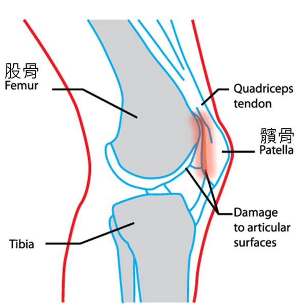 下图是膝关节的侧面观,可以看到髌骨和股骨末端因摩擦产生疼痛(示意图