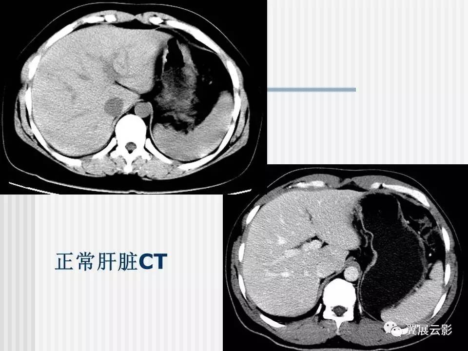 脂肪肝的影像学诊断