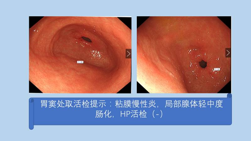 幽门螺旋杆菌胃镜图片图片