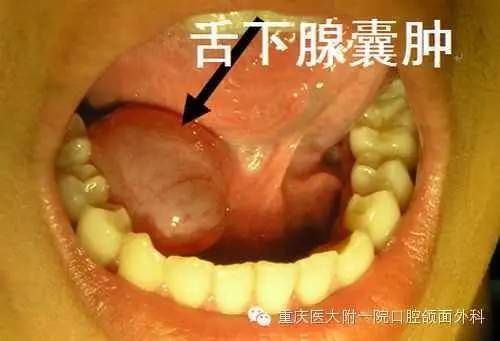 口腔良性肿瘤图片