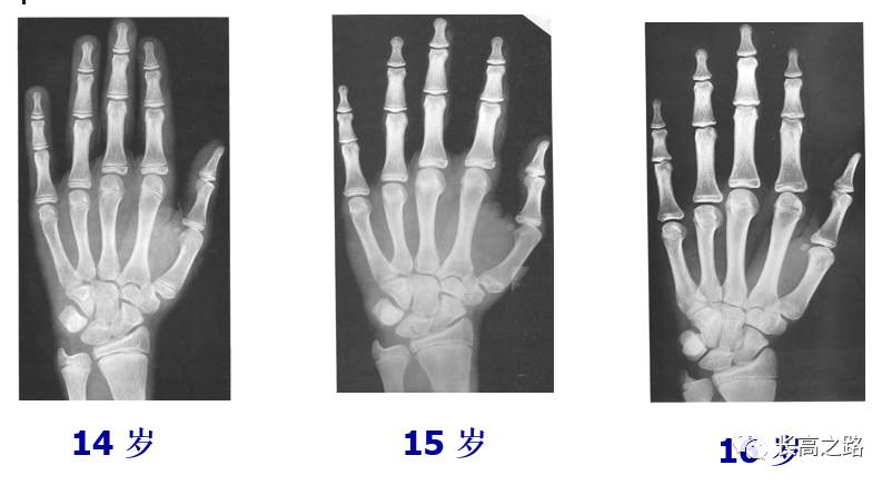 教你简单识别孩子的骨龄片
