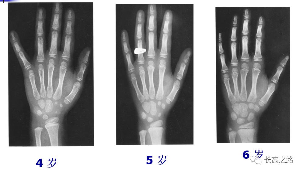 骨龄片子怎么看图片