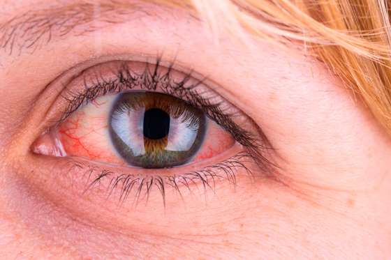 眼白变黄是肝脏功能不好的信号之一,可能也是肝脏疾病最明显的特征