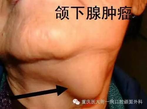 颌下腺的位置 真人图片