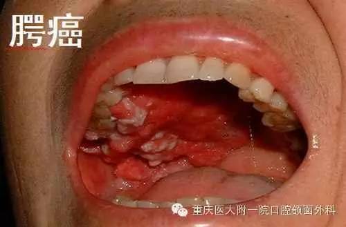 口腔恶性肿瘤的特征图片