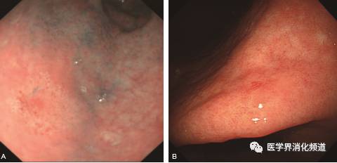 胃癌病灶图片图片