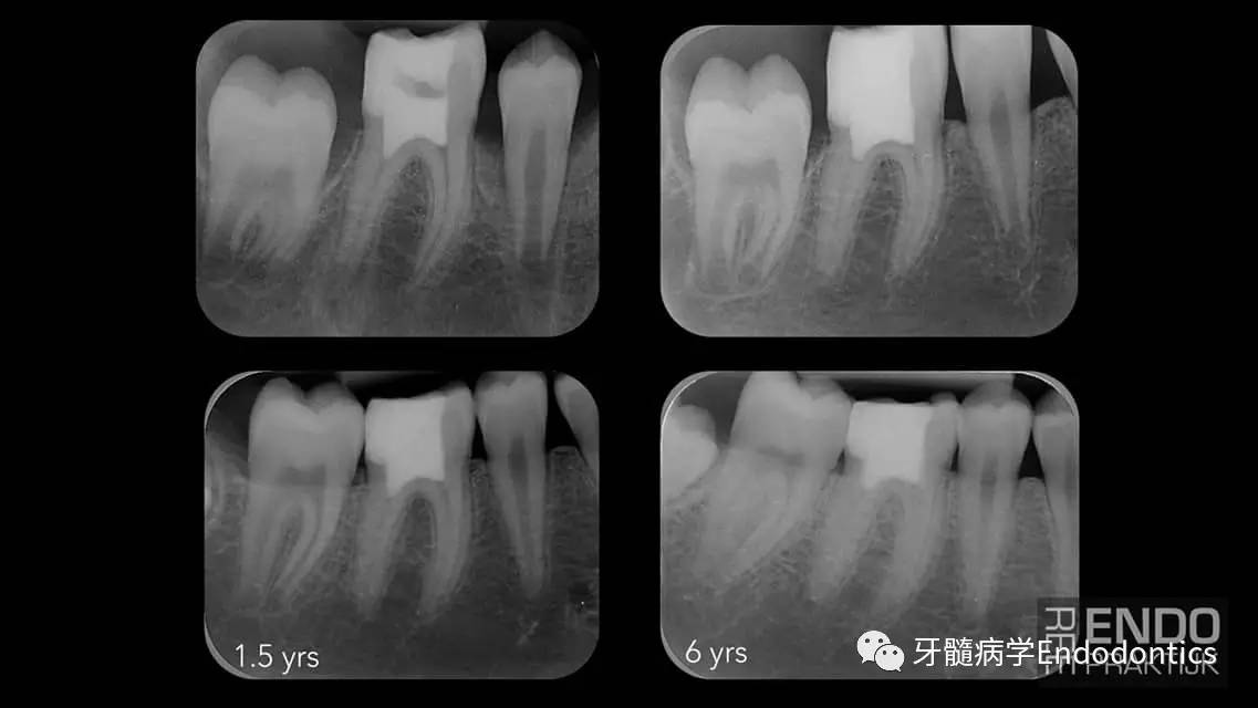左下颌第一磨牙图片图片