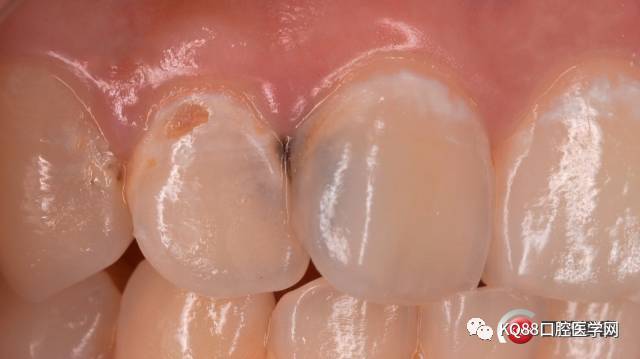 例如:平滑面龋其实这个白化现象大家都很了解,它就是牙齿表面的白垩色