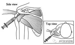 肩关节封闭注射部位图图片