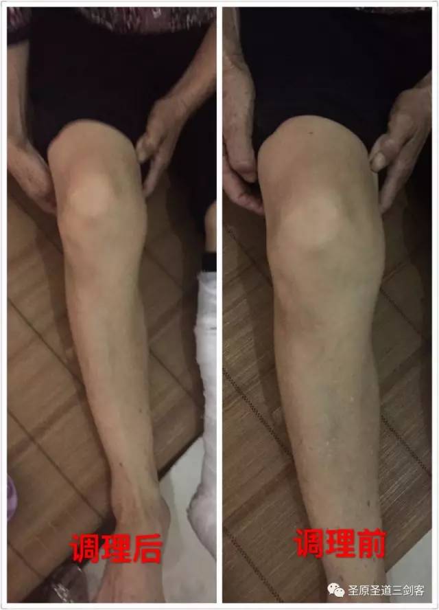膝盖积水最佳治疗方法图片