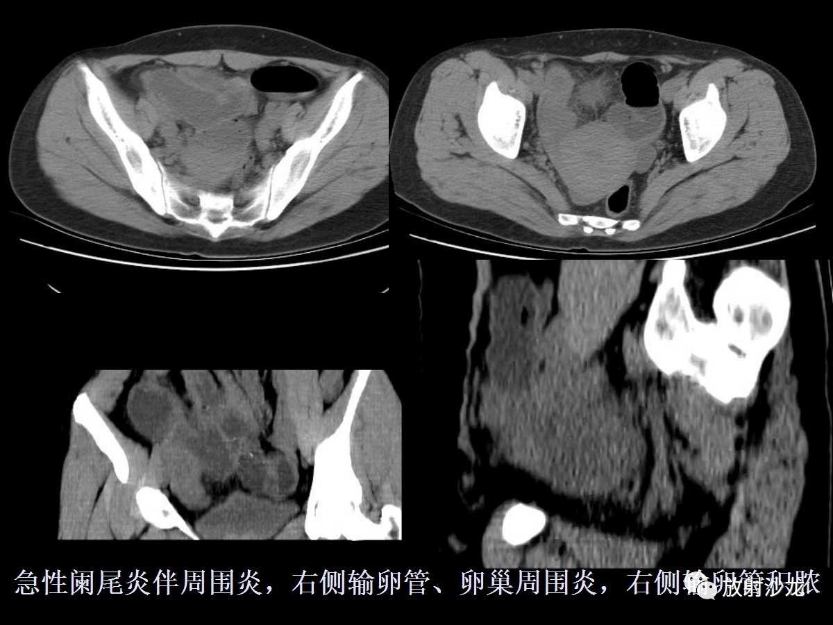 急性阑尾炎ct片图片图片