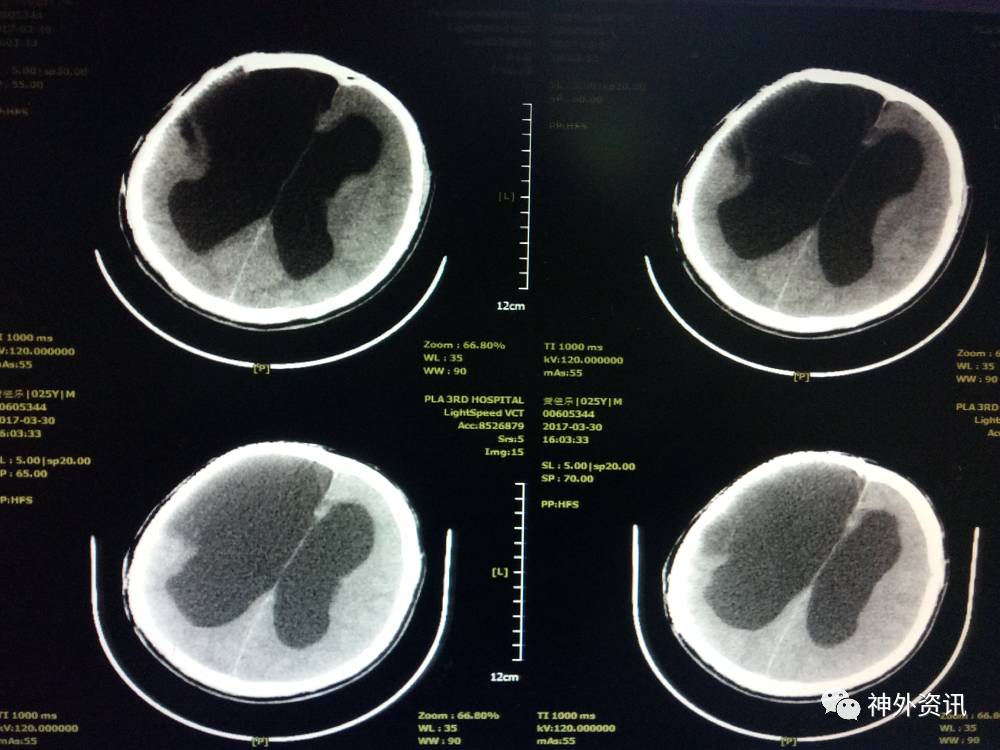 一例重型顱腦損傷合併術後腦積水並顱內感染的治療體會