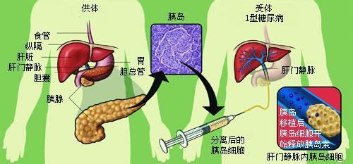 引起糖尿病的原因及治療方法