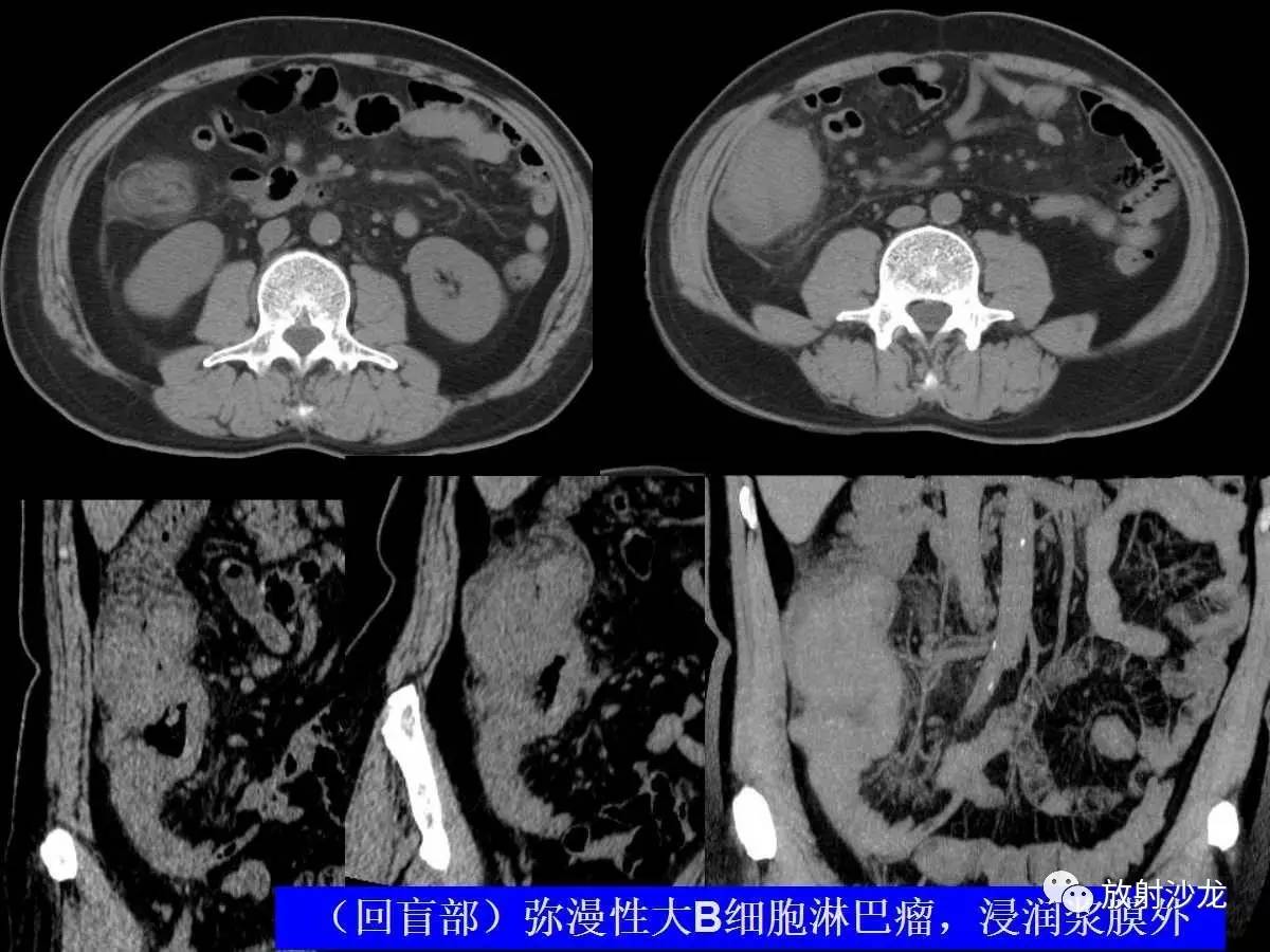 急性阑尾炎ct片图片图片