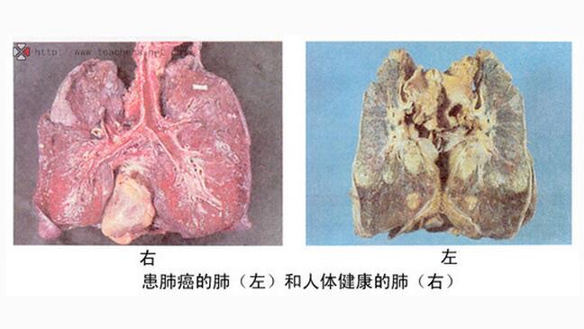 胸悶大半年,一查就是肺癌晚期,癌症信號要警惕