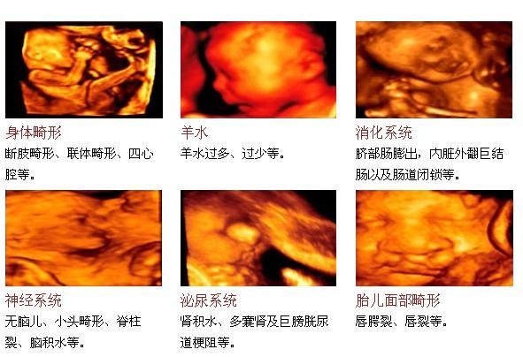 1,胎儿面部畸形:如唇腭裂等