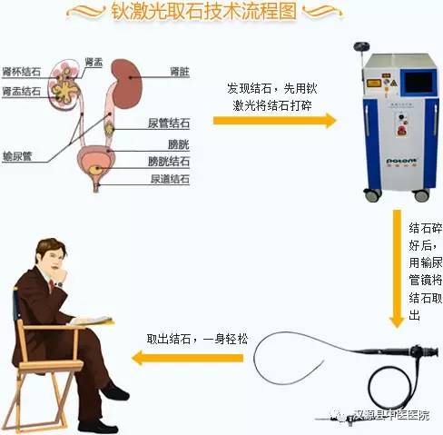 钬激光碎石术顽固结石的克星汉源县中医医院泌尿外科成功开展钬激光