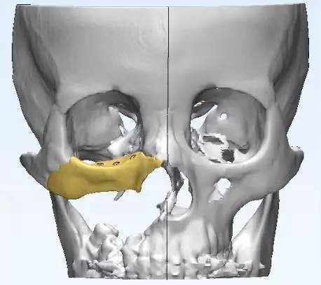 行上颌窦恶性肿瘤根治术,切除了右侧上颌窦的相应骨壁