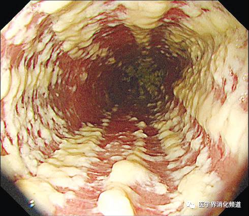 看圖下診斷,這種食管黏膜豆腐渣樣長條狀白斑是什麼病所致?