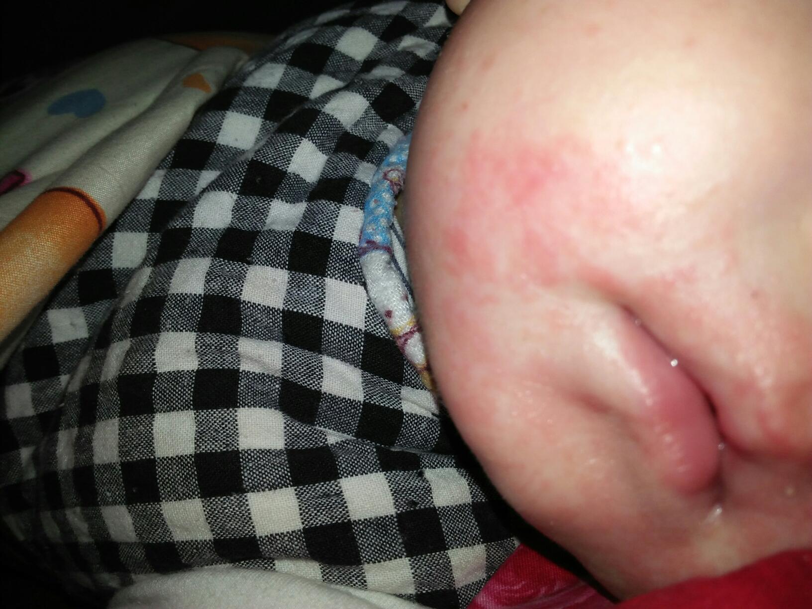 婴儿脸上长奶癣图片图片
