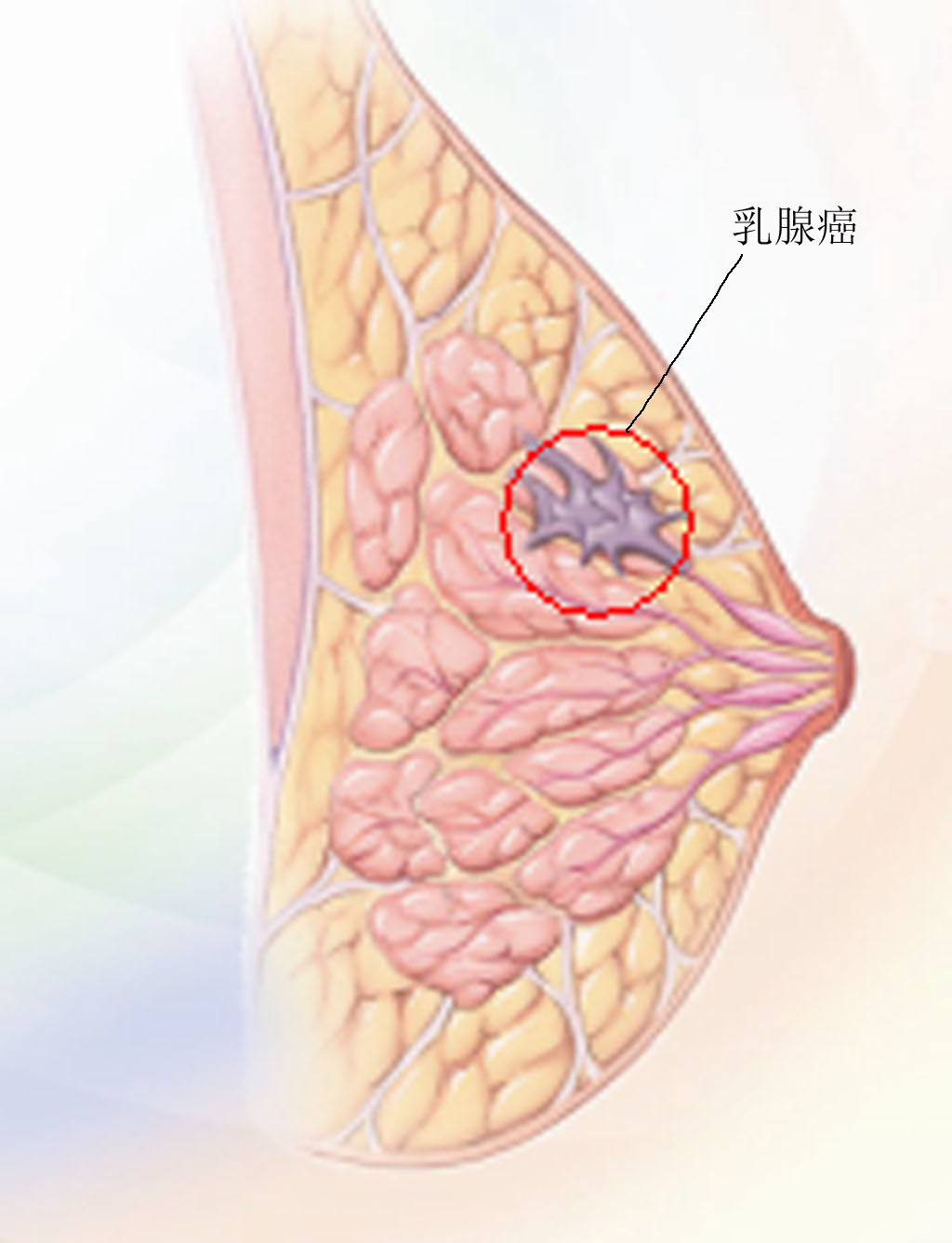 炎性乳腺癌症状图片