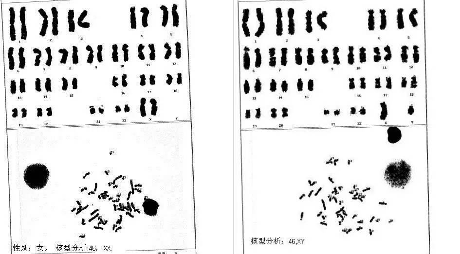 染色体核型命名如下 正常男性为46