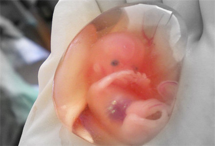 胎儿流产图图片
