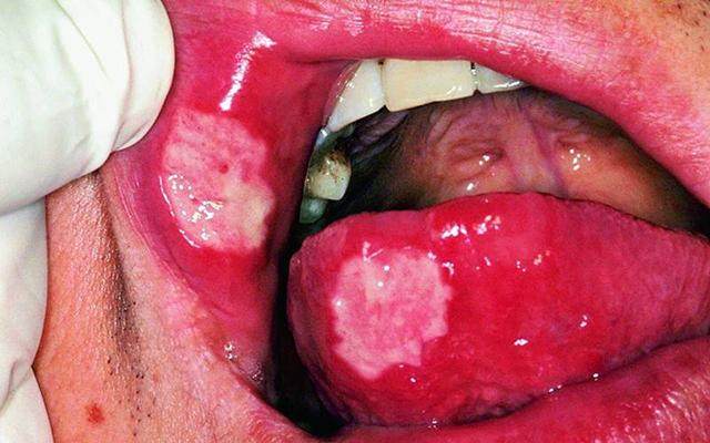 虚火上炎,但吸烟人牙龈出血大多是因为口中缺氧,口腔不洁引起的牙周病