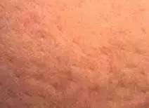 乳腺癌橘皮 早期图片
