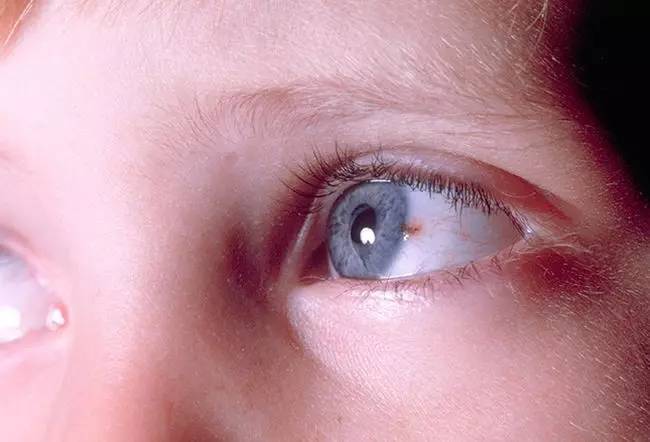 眼内黑色素瘤主要指葡萄膜黑色素瘤,而葡萄膜又包括虹膜,脉络膜,睫状