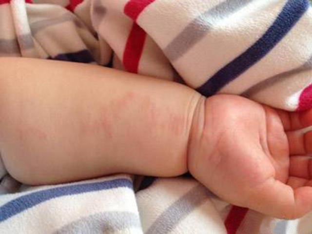 婴儿皮肤病癣图片图片