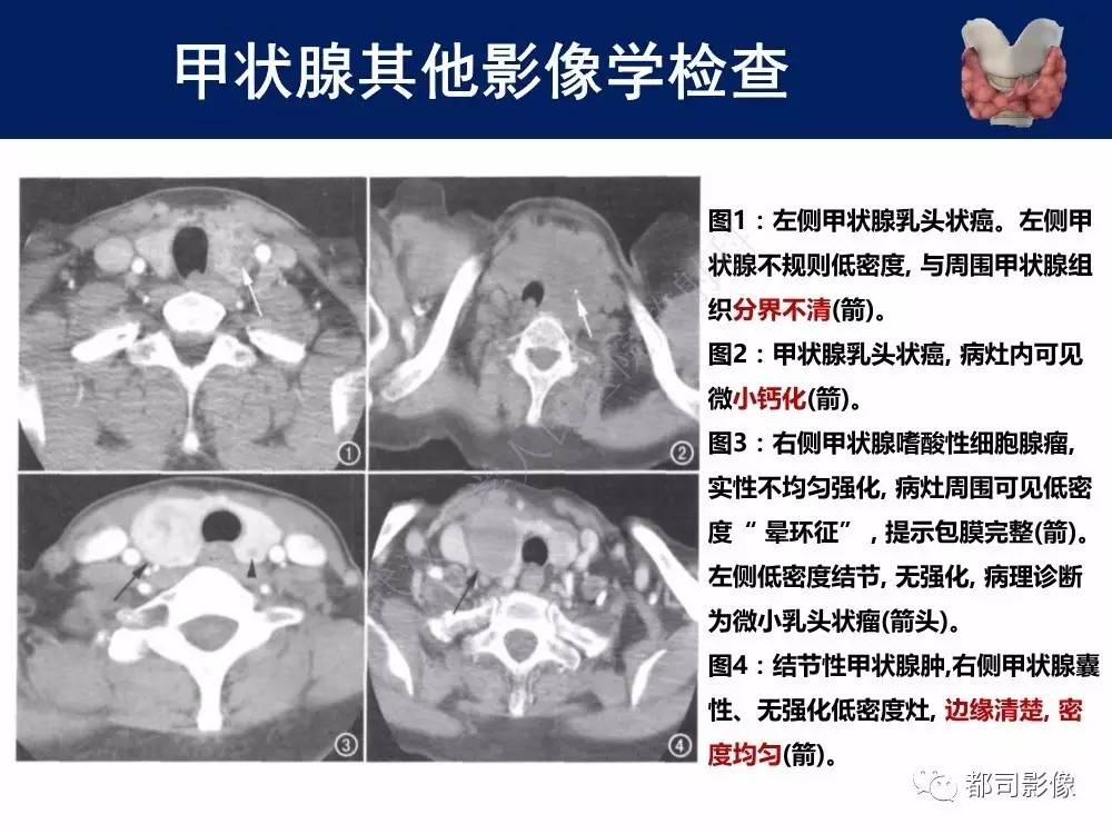 甲状腺CT图解图片