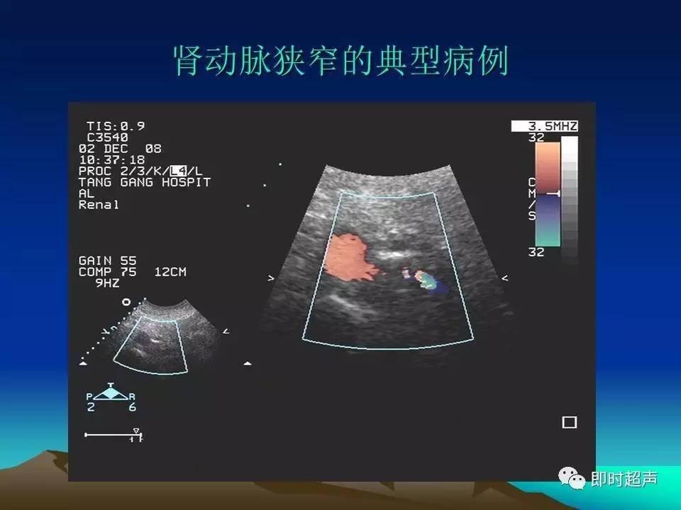 肾动脉解剖位置超声图图片