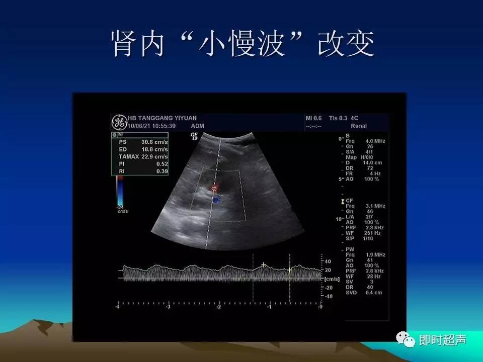 肾动脉解剖位置超声图图片