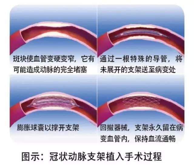 冠状动脉支架植入手术过程