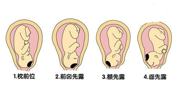 胎儿肩右前位示意图图片