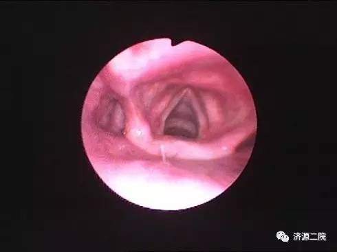 一个正常人的喉镜图片图片